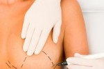 Lipoplasty and Botox remain most performed plastic procedures